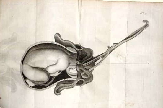 Baudelocque