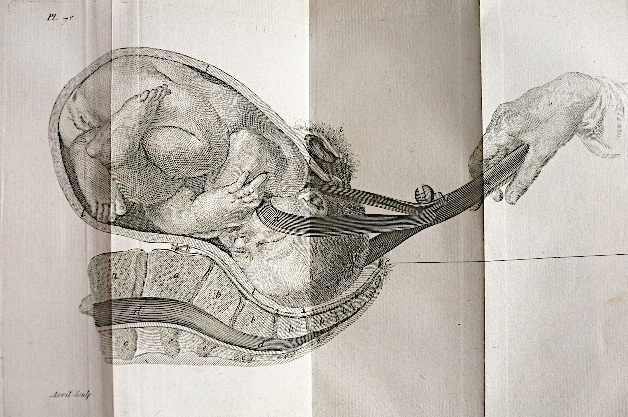 Baudelocque 2